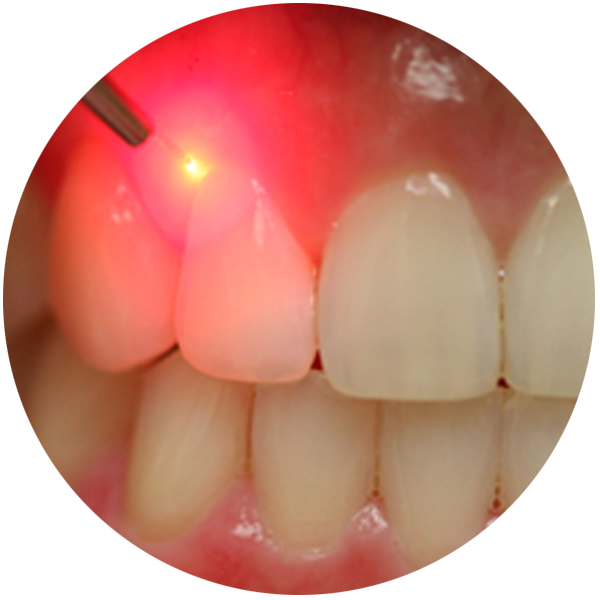 Soft Tissue Diode Lasers