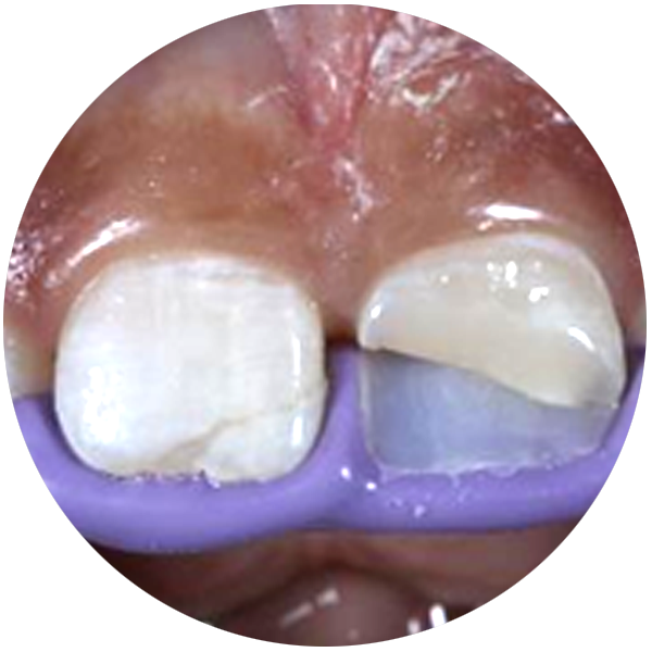 Universal Esthetic Composite